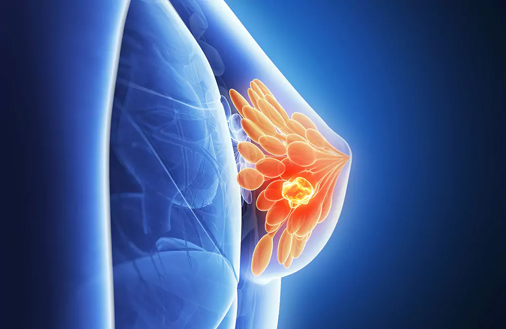 Breast Cancer