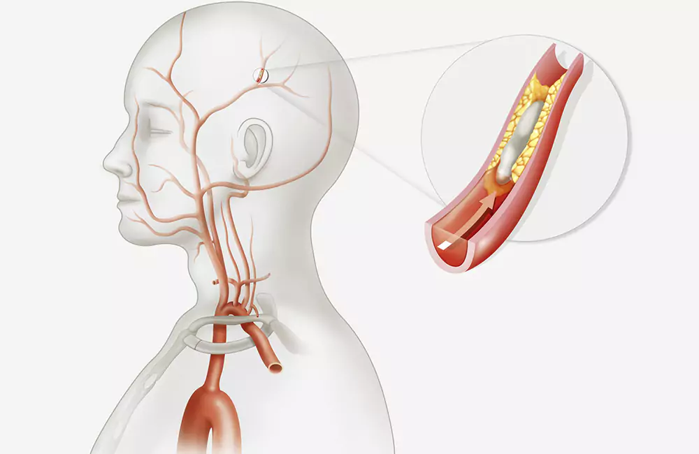 Stroke or Paralysis