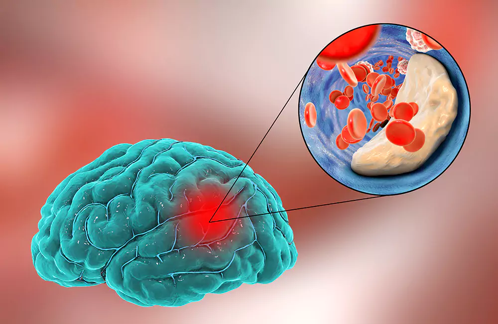 Stroke or Paralysis